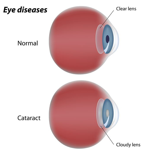 Optique Elegance | Cataracts, Glaucoma Management and Diabetic Eye Exams