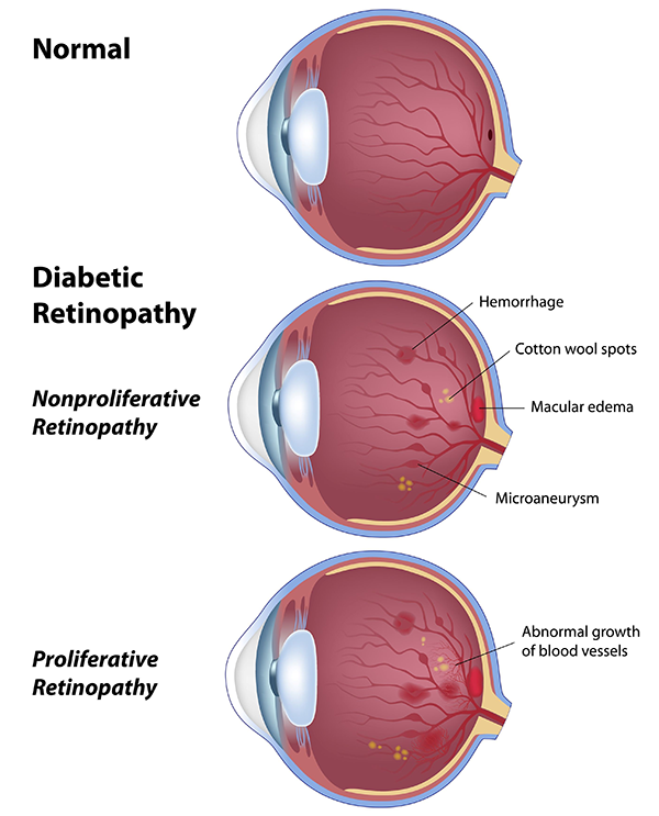 Optique Elegance | Diabetic Eye Exams, Dry Eye Treatment and Cataracts